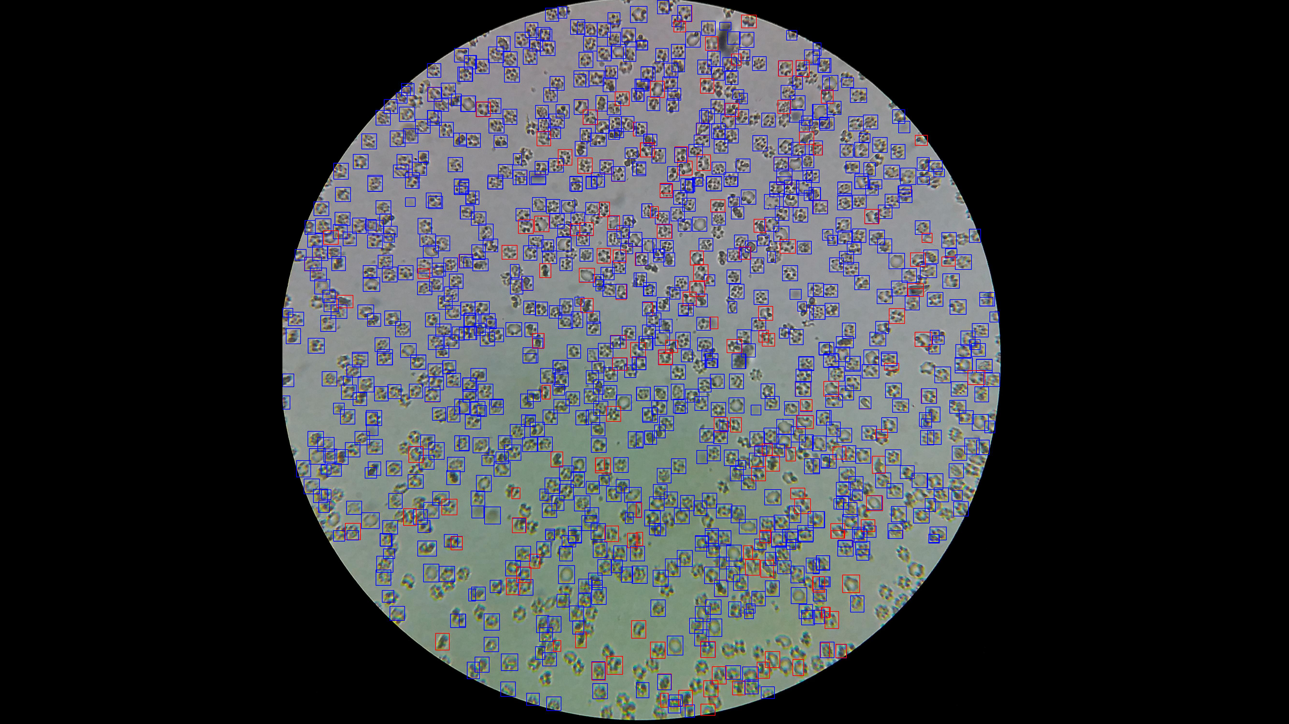 Sickle Cell Detection